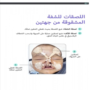 اللصقات للشفة المشقوقة من جهتين